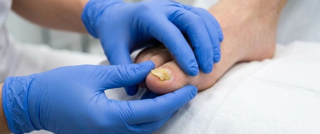 Tratamiento de Avulsión Química en Leganés con los mejores podólogos.