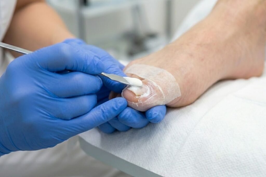 Tratamiento de Avulsión Química en Leganés con los mejores podólogos. Fase 2.