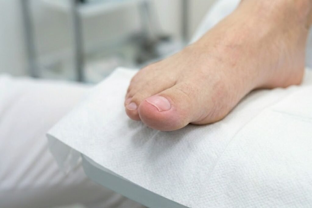 Tratamiento de Avulsión Química en Leganés con los mejores podólogos. Fase 4.