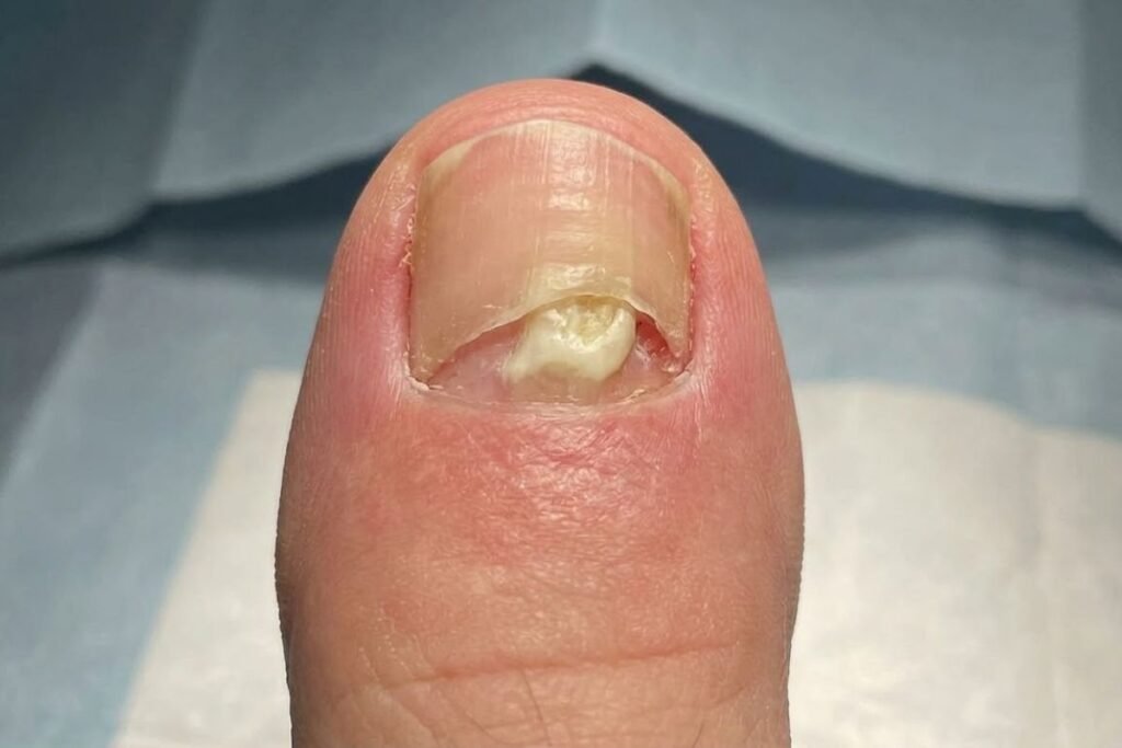 Cirugía de Exostosis Subungueal