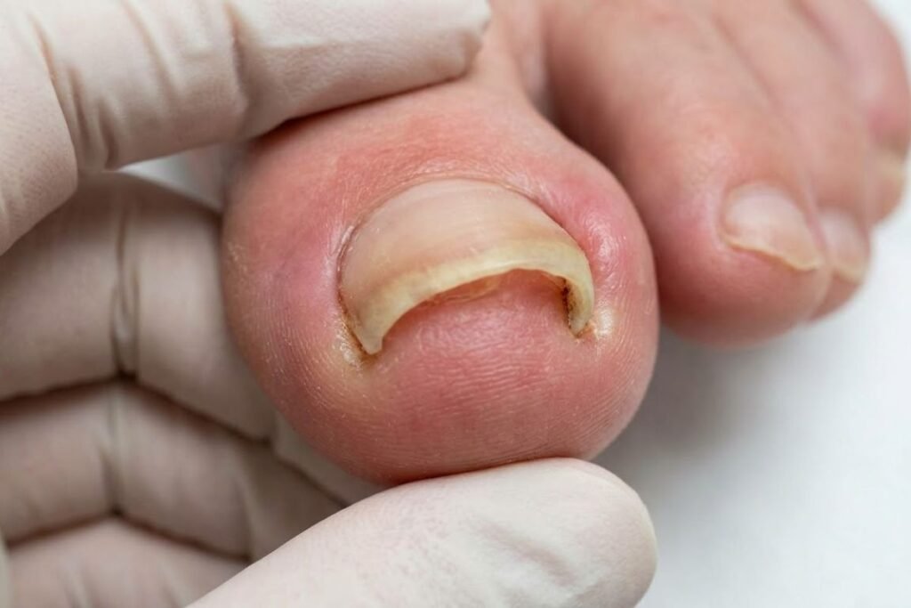 Tratamientos de Ortonixia para la Uña Encarnada en Leganés