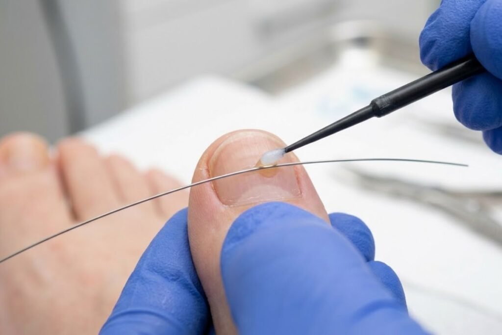 Tratamientos de Ortonixia para la Uña Encarnada en Leganés 2