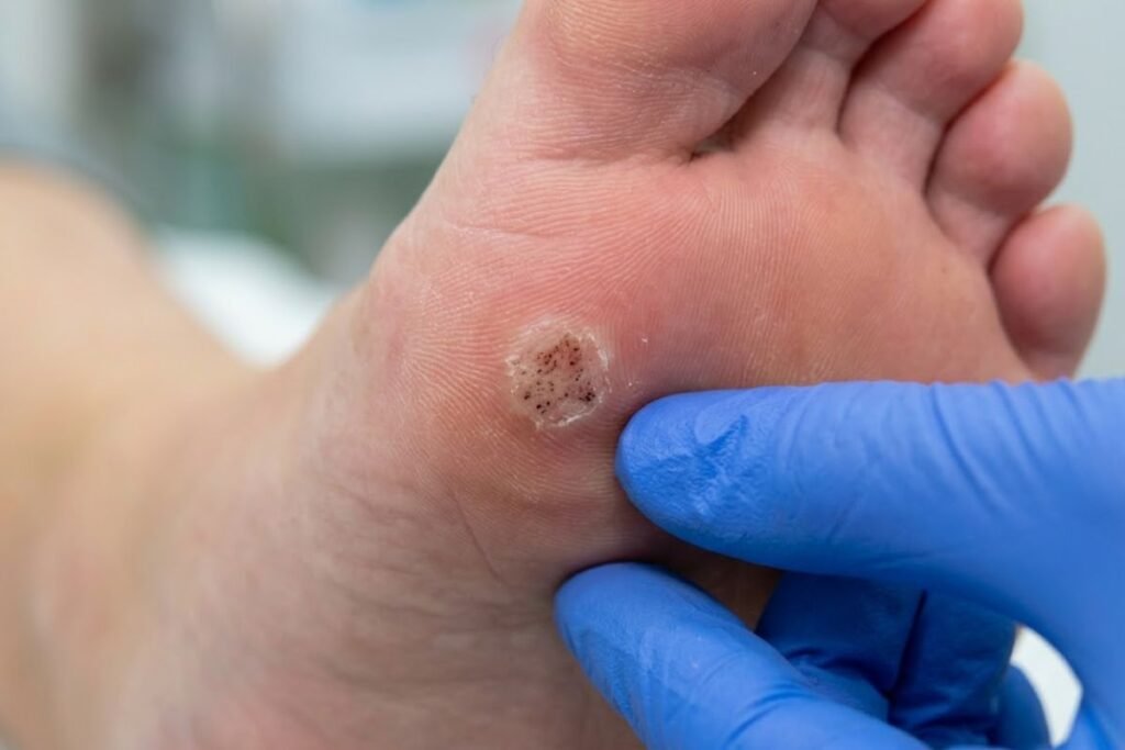 Tratamiento de Papilomas (Verrugas Plantares): Eliminación efectiva con Ácido Nítrico y Cantaridina 2