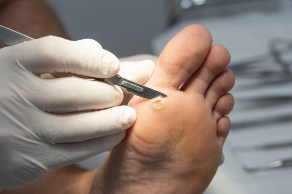 Tratamiento de Papilomas (Verrugas Plantares): Eliminación efectiva con Ácido Nítrico y Cantaridina